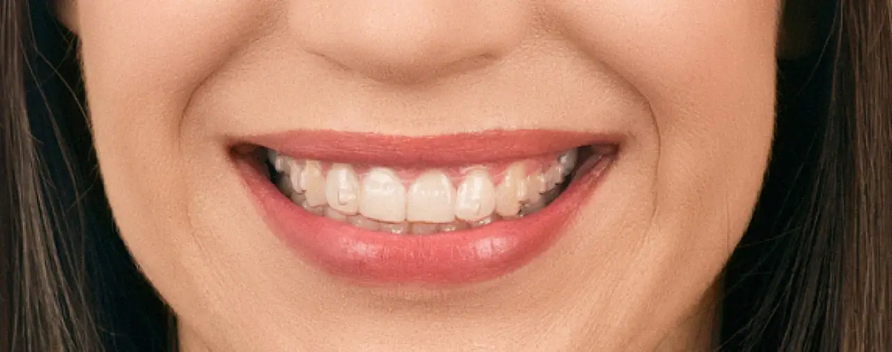 Ordoline nevidni zobni aparati - alignerji